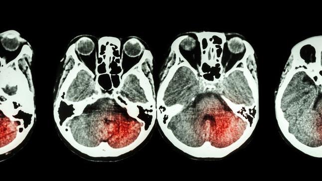 Image of slice through human brain showing location of a stroke.